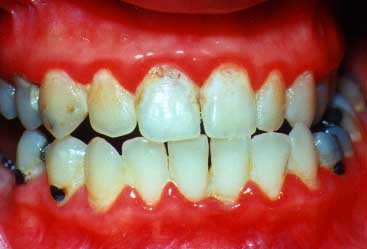 periodontal disease